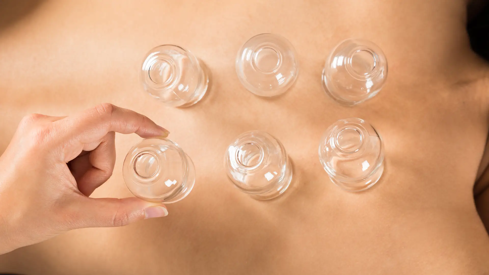 Myofascial Cupping